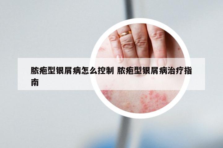 脓疱型银屑病怎么控制 脓疱型银屑病治疗指南