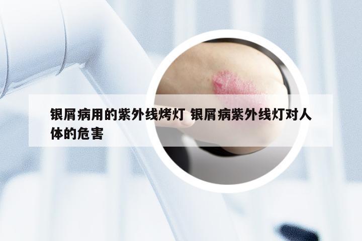 银屑病用的紫外线烤灯 银屑病紫外线灯对人体的危害