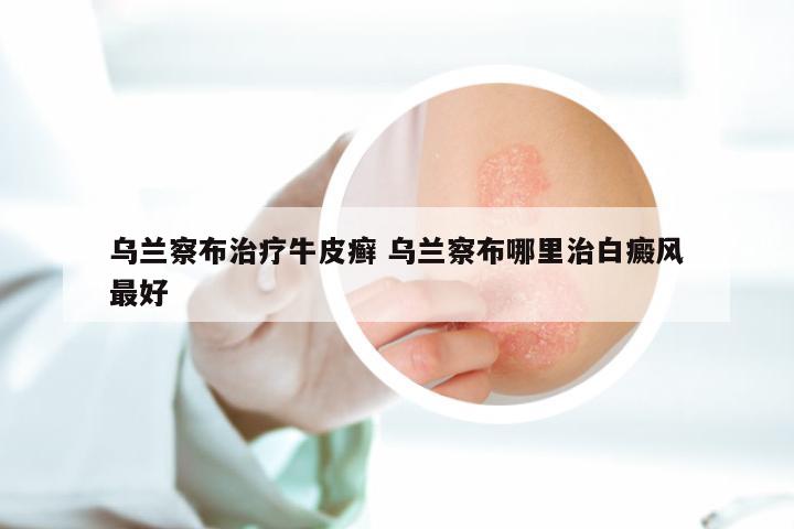 乌兰察布治疗牛皮癣 乌兰察布哪里治白癜风最好