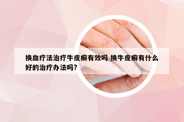 换血疗法治疗牛皮癣有效吗 换牛皮癣有什么好的治疗办法吗?