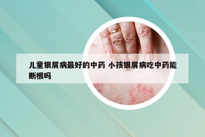 儿童银屑病最好的中药 小孩银屑病吃中药能断根吗