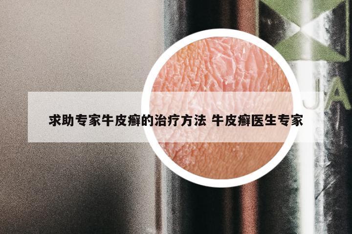 求助专家牛皮癣的治疗方法 牛皮癣医生专家