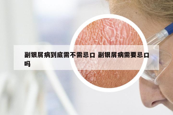 副银屑病到底需不需忌口 副银屑病需要忌口吗