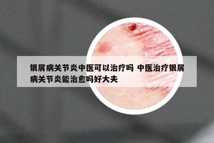 银屑病关节炎中医可以治疗吗 中医治疗银屑病关节炎能治愈吗好大夫