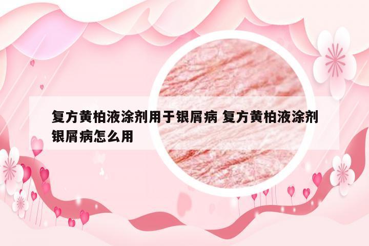 复方黄柏液涂剂用于银屑病 复方黄柏液涂剂银屑病怎么用