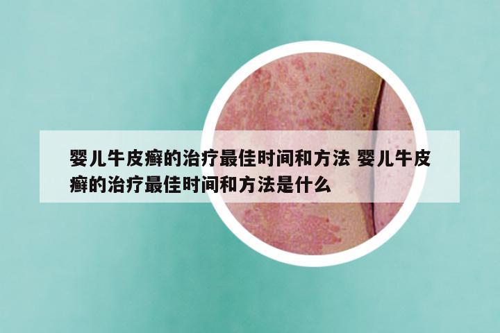 婴儿牛皮癣的治疗最佳时间和方法 婴儿牛皮癣的治疗最佳时间和方法是什么