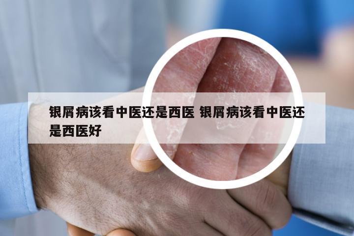 银屑病该看中医还是西医 银屑病该看中医还是西医好