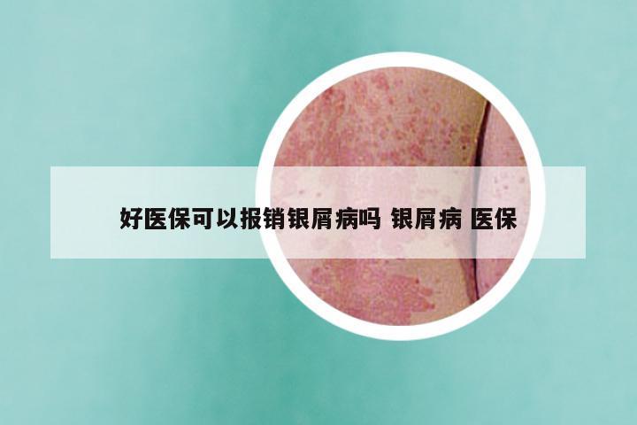 好医保可以报销银屑病吗 银屑病 医保