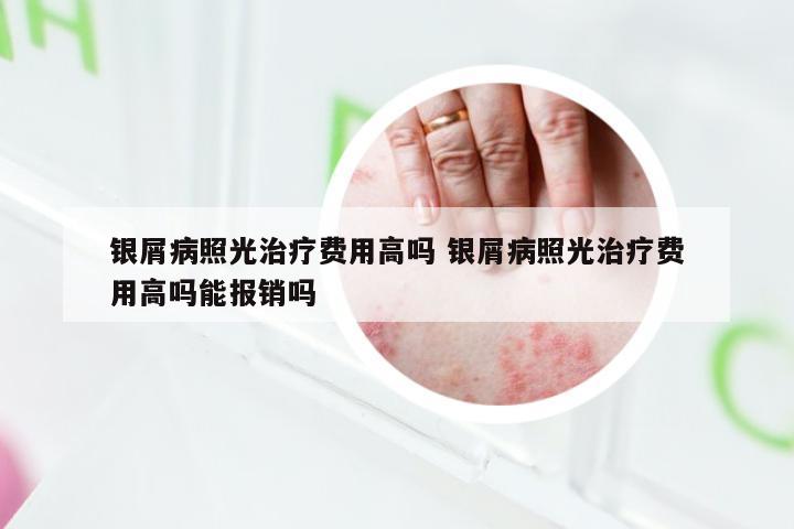 银屑病照光治疗费用高吗 银屑病照光治疗费用高吗能报销吗