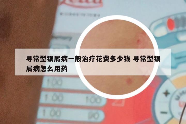 寻常型银屑病一般治疗花费多少钱 寻常型银屑病怎么用药