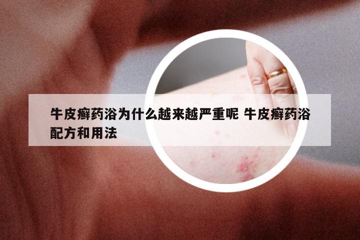 牛皮癣药浴为什么越来越严重呢 牛皮癣药浴配方和用法