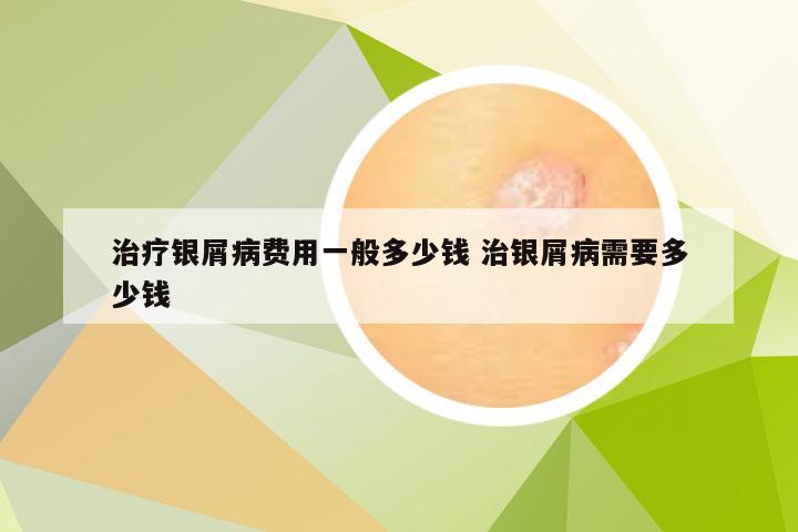 治疗银屑病费用一般多少钱 治银屑病需要多少钱