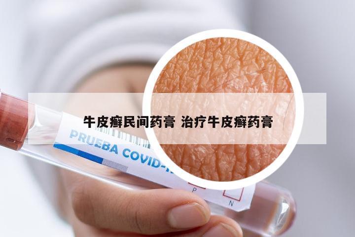 牛皮癣民间药膏 治疗牛皮癣药膏