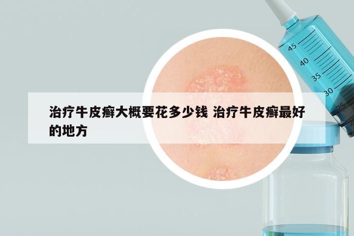 治疗牛皮癣大概要花多少钱 治疗牛皮癣最好的地方