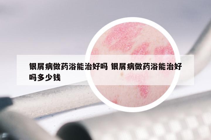 银屑病做药浴能治好吗 银屑病做药浴能治好吗多少钱