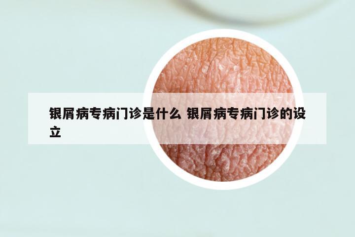 银屑病专病门诊是什么 银屑病专病门诊的设立