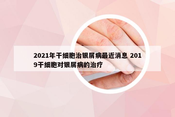 2021年干细胞治银屑病最近消息 2019干细胞对银屑病的治疗