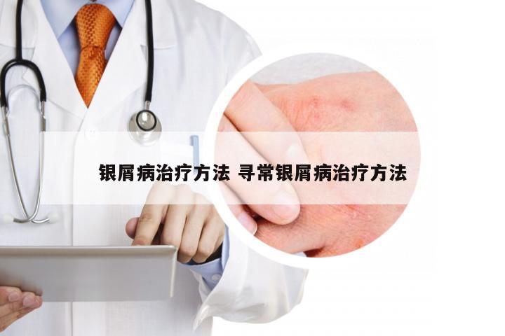银屑病治疗方法 寻常银屑病治疗方法