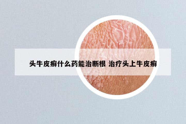 头牛皮癣什么药能治断根 治疗头上牛皮癣