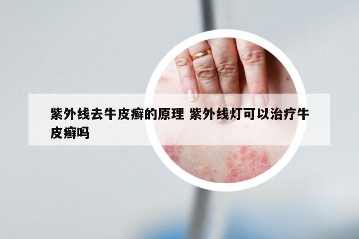 紫外线去牛皮癣的原理 紫外线灯可以治疗牛皮癣吗