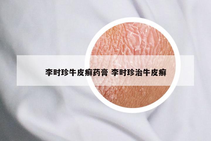 李时珍牛皮癣药膏 李时珍治牛皮癣