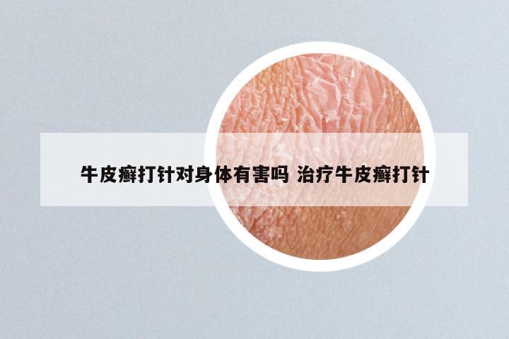 牛皮癣打针对身体有害吗 治疗牛皮癣打针