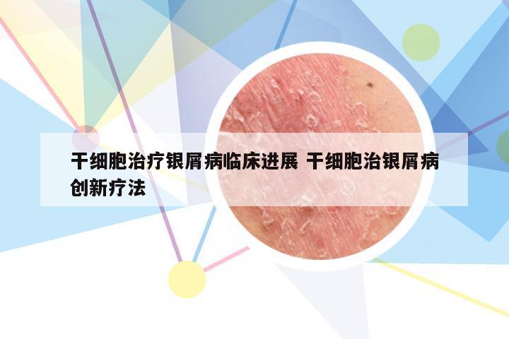 干细胞治疗银屑病临床进展 干细胞治银屑病创新疗法