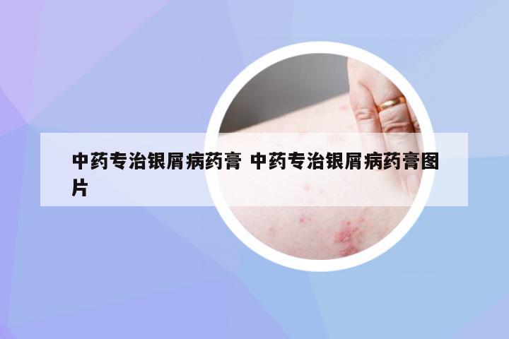 中药专治银屑病药膏 中药专治银屑病药膏图片