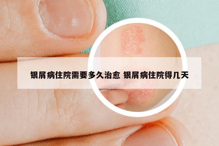 银屑病住院需要多久治愈 银屑病住院得几天