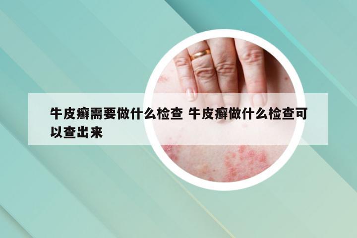 牛皮癣需要做什么检查 牛皮癣做什么检查可以查出来