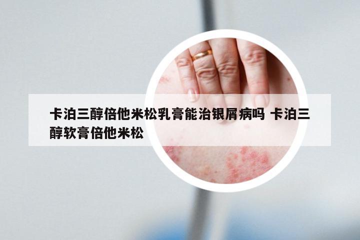 卡泊三醇倍他米松乳膏能治银屑病吗 卡泊三醇软膏倍他米松