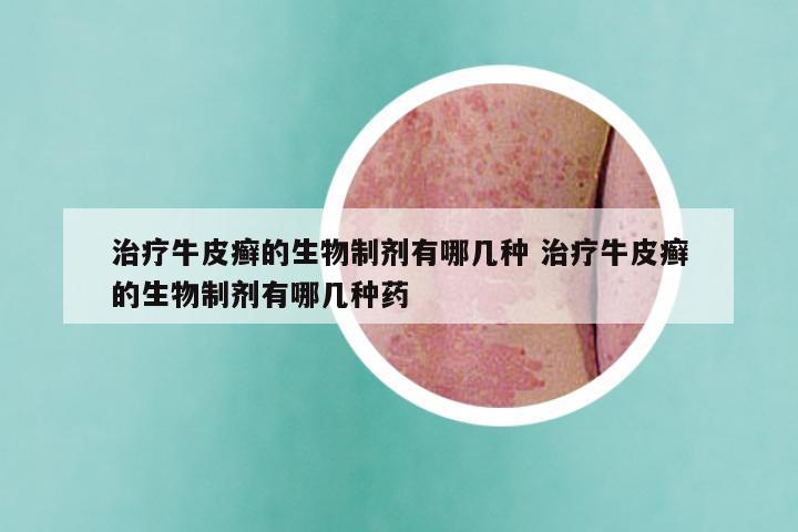 治疗牛皮癣的生物制剂有哪几种 治疗牛皮癣的生物制剂有哪几种药