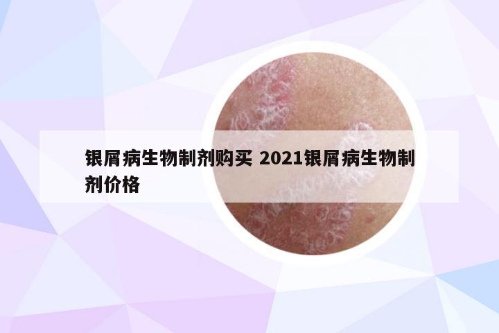银屑病生物制剂购买 2021银屑病生物制剂价格