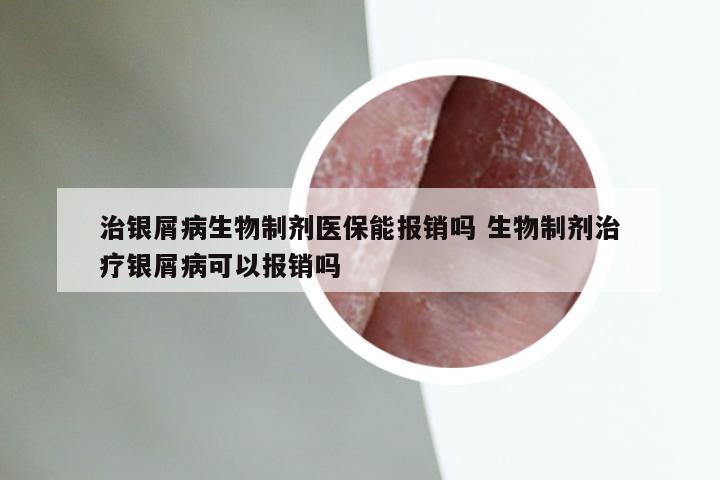 治银屑病生物制剂医保能报销吗 生物制剂治疗银屑病可以报销吗