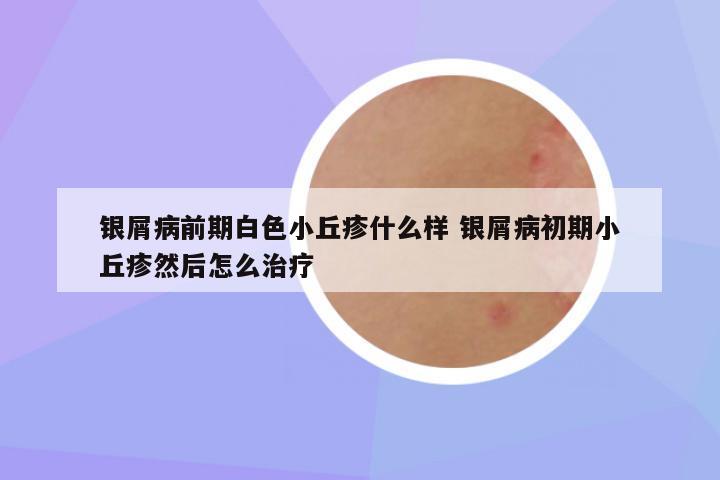 银屑病前期白色小丘疹什么样 银屑病初期小丘疹然后怎么治疗