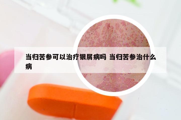 当归苦参可以治疗银屑病吗 当归苦参治什么病