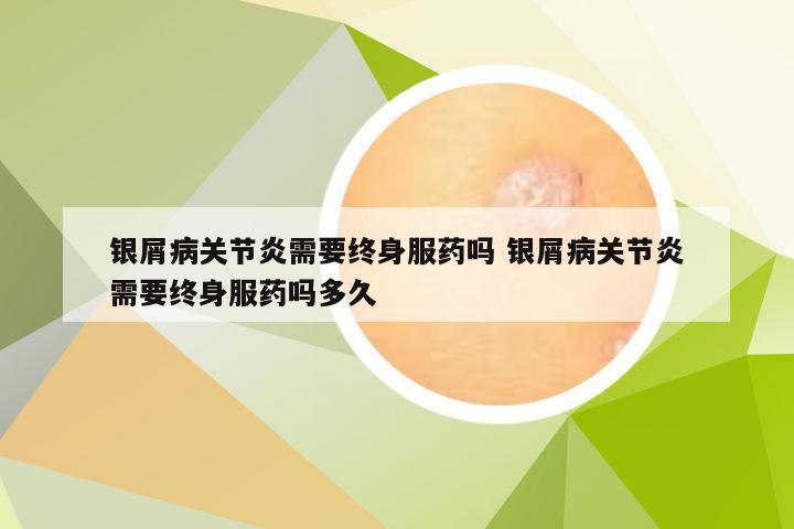 银屑病关节炎需要终身服药吗 银屑病关节炎需要终身服药吗多久