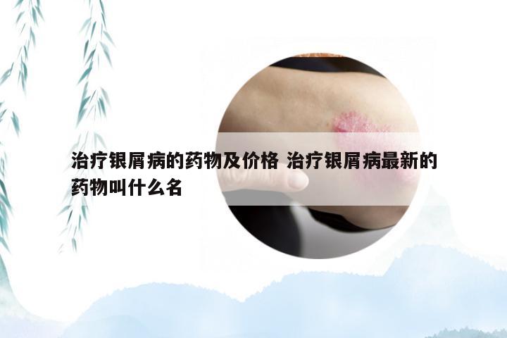 治疗银屑病的药物及价格 治疗银屑病最新的药物叫什么名