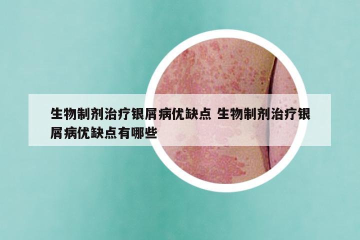 生物制剂治疗银屑病优缺点 生物制剂治疗银屑病优缺点有哪些