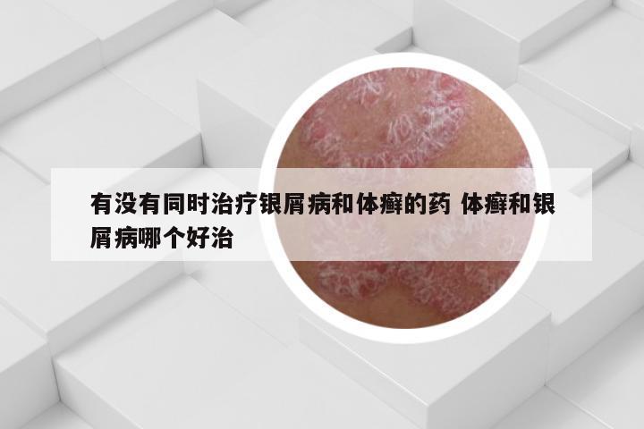 有没有同时治疗银屑病和体癣的药 体癣和银屑病哪个好治
