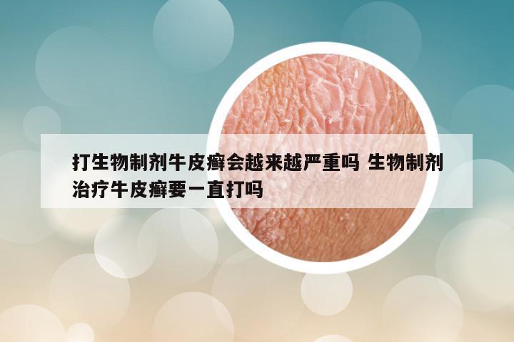 打生物制剂牛皮癣会越来越严重吗 生物制剂治疗牛皮癣要一直打吗