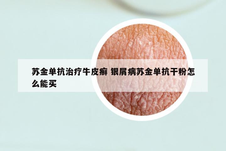 苏金单抗治疗牛皮癣 银屑病苏金单抗干粉怎么能买