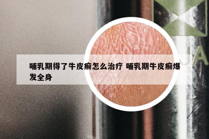 哺乳期得了牛皮癣怎么治疗 哺乳期牛皮癣爆发全身