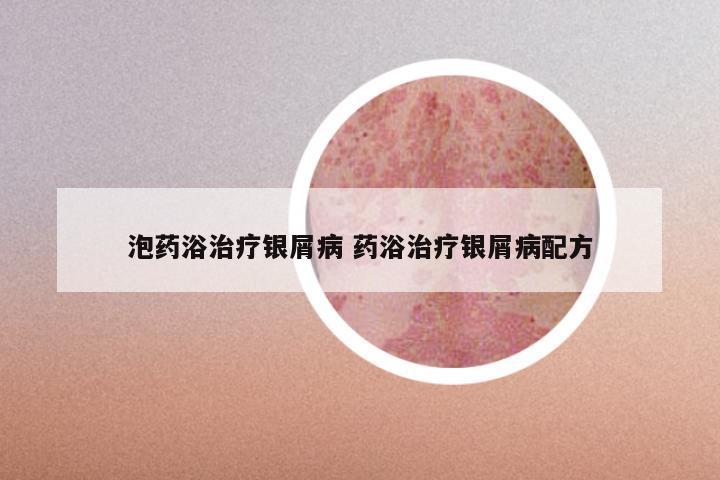 泡药浴治疗银屑病 药浴治疗银屑病配方