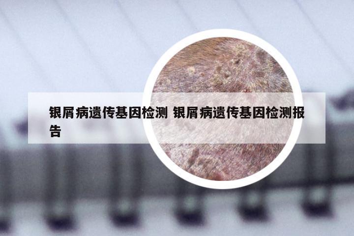 银屑病遗传基因检测 银屑病遗传基因检测报告