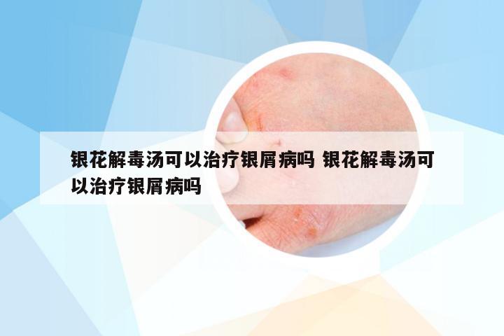 银花解毒汤可以治疗银屑病吗 银花解毒汤可以治疗银屑病吗