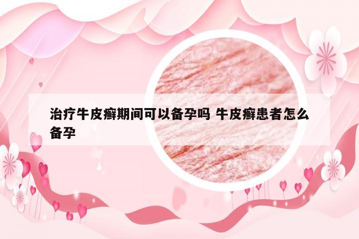 治疗牛皮癣期间可以备孕吗 牛皮癣患者怎么备孕