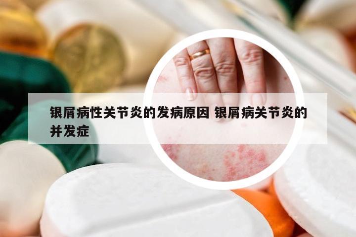 银屑病性关节炎的发病原因 银屑病关节炎的并发症