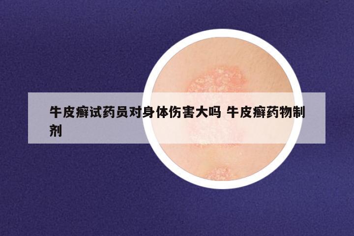牛皮癣试药员对身体伤害大吗 牛皮癣药物制剂