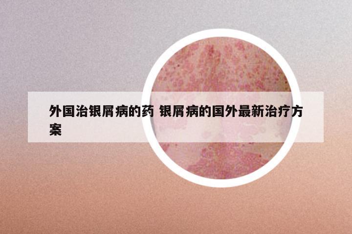 外国治银屑病的药 银屑病的国外最新治疗方案